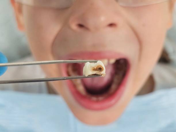 Best Chipped Tooth Repair Near Me  in Rosenberg, TX