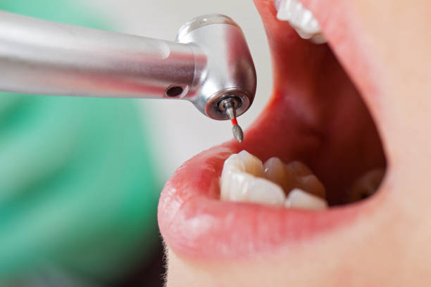 Teeth Whitening in TX
